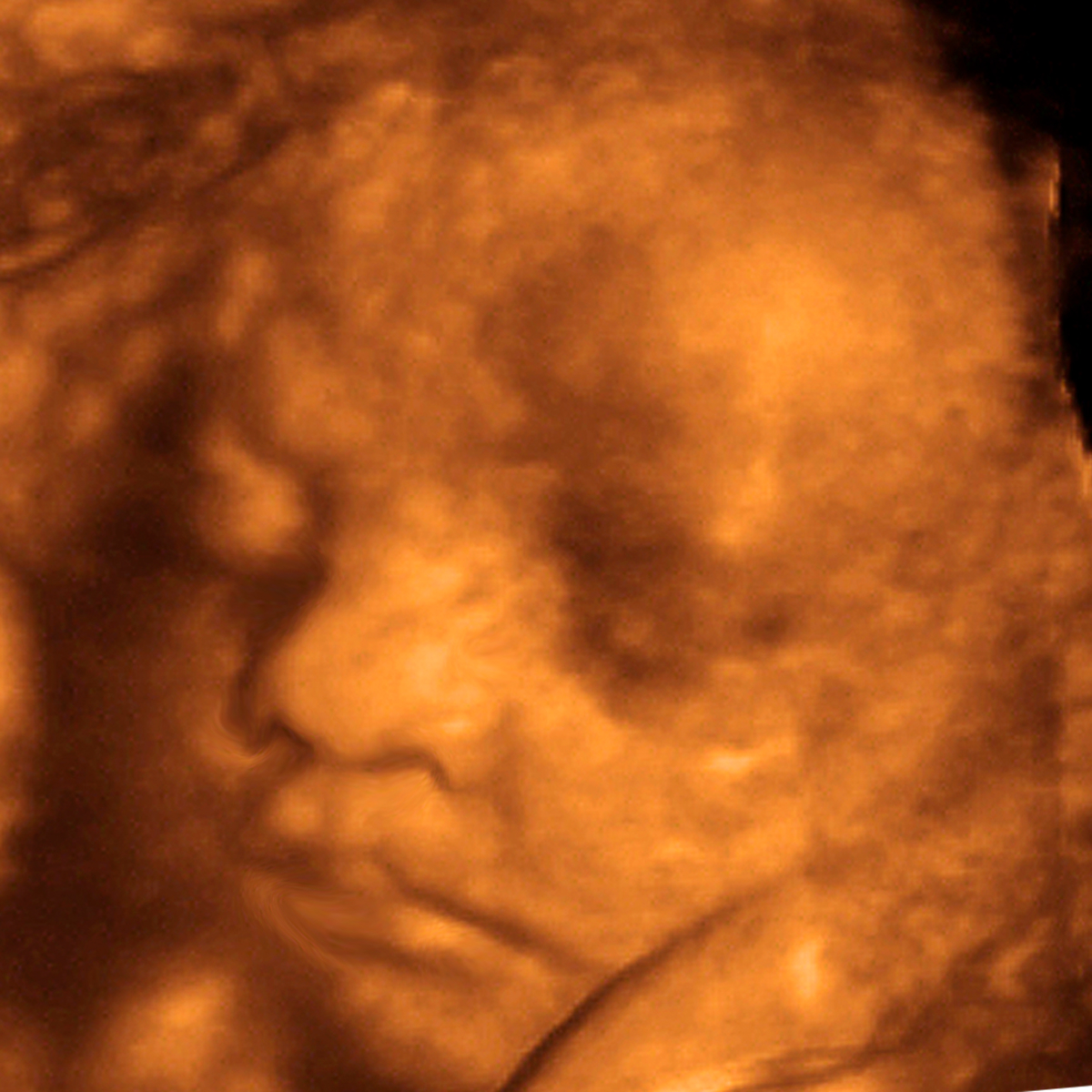 3D Ultrasound scan 2